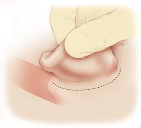 Courtesy of the Stanford Otolaryngology Atlas. 