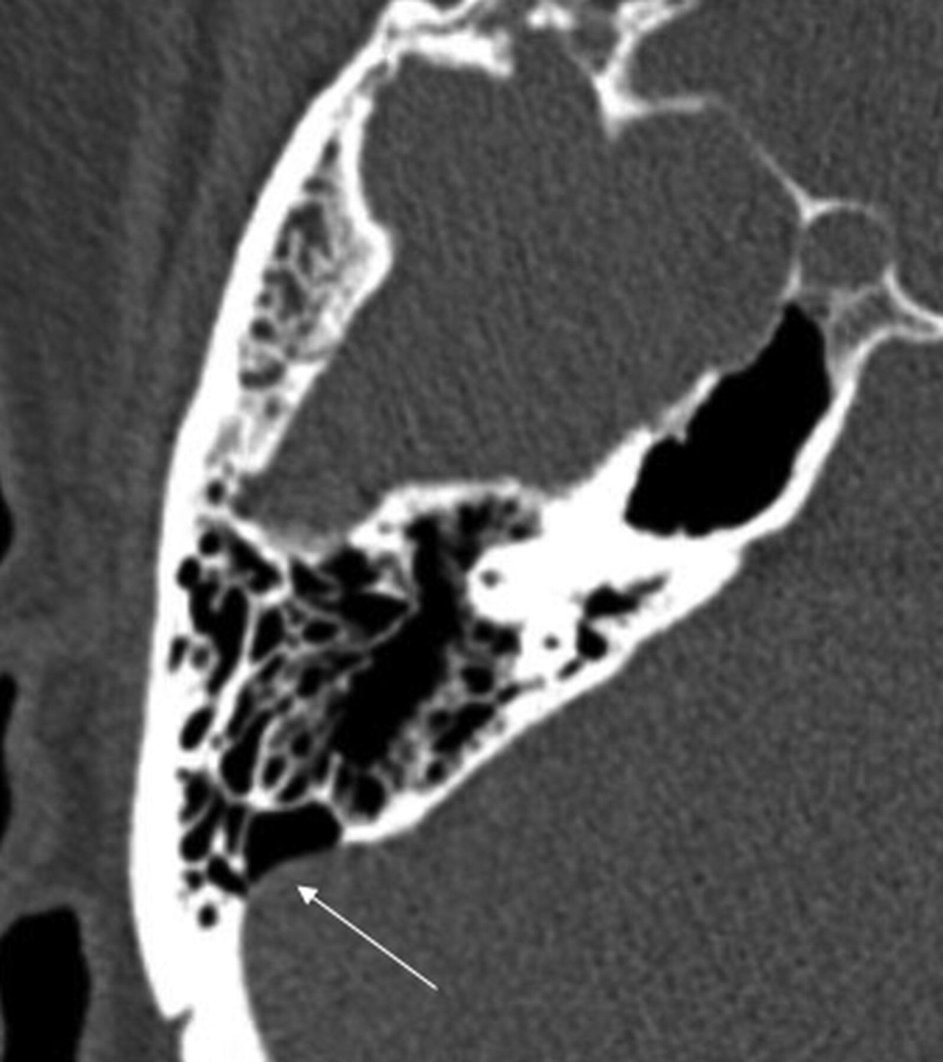 Pulsatile Tinnitus: Causes, Symptoms, and Solutions. A detailed review