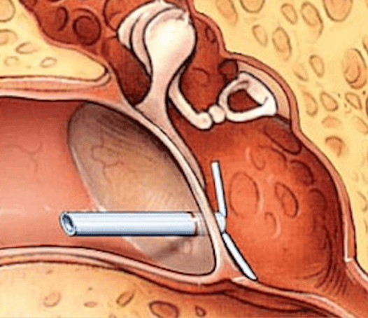 Myringotomy and Ear tubes: Procedure, Benefits, Risks, and Aftercare