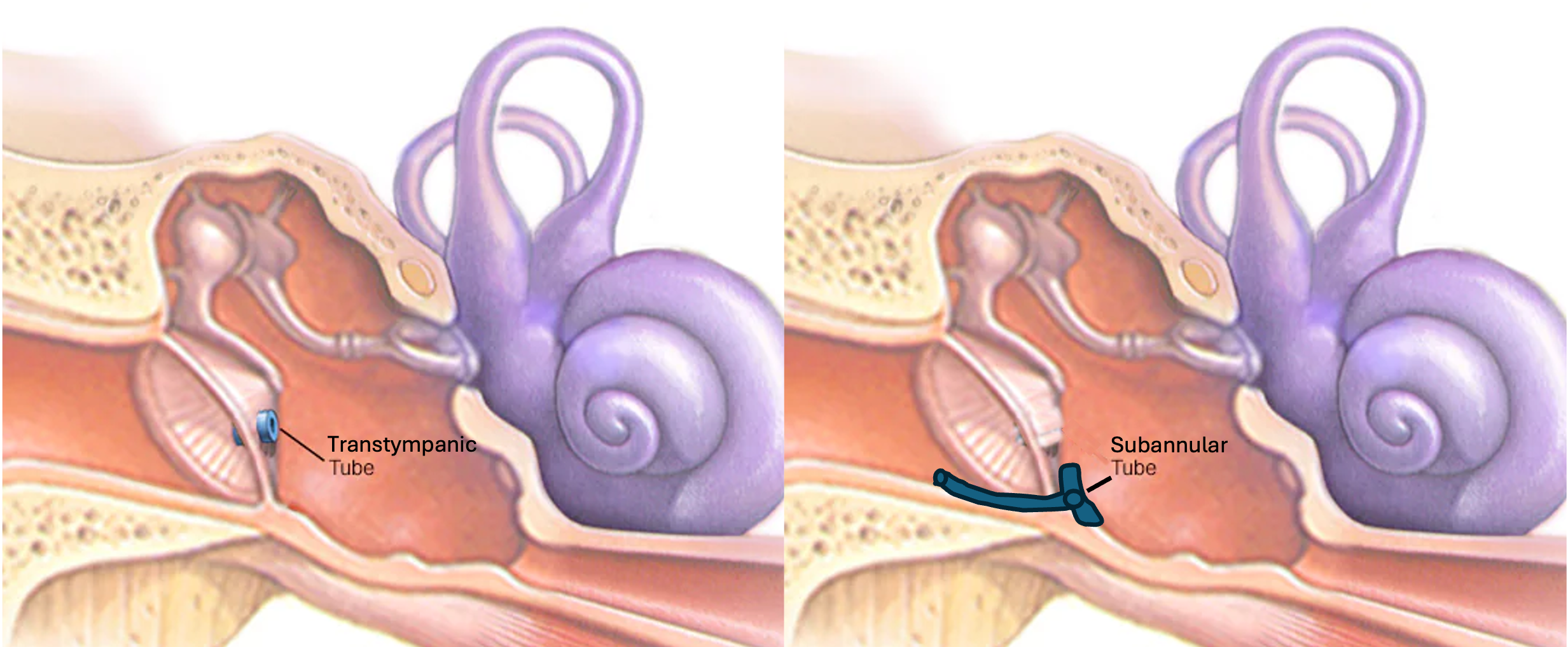 Subannular tube